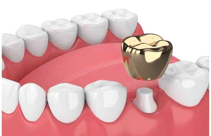 Gold Tooth Crown Facts and History